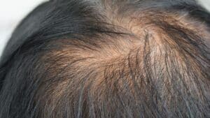 Scalp Micropigmentation For Women: Is It Effective?