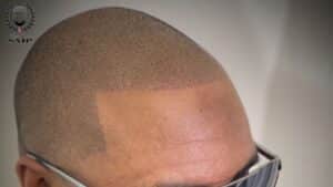 3 Scalp Micropigmentation Hairline Options