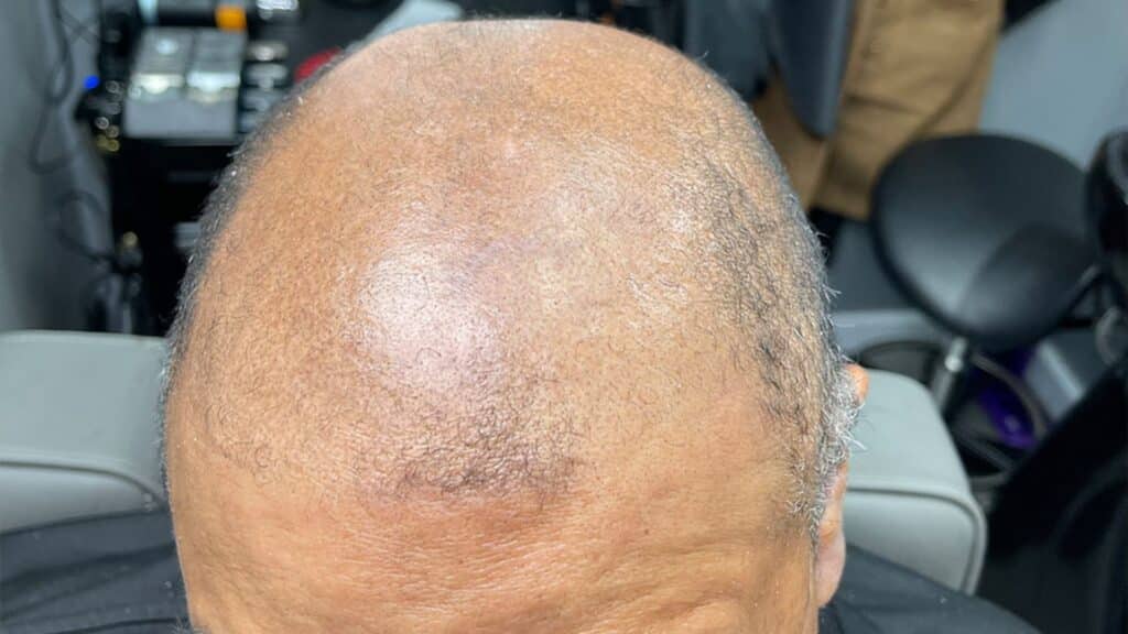 Does Dandruff Cause Hair Loss & Can Dandruff Cause Baldness?