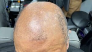 Does Dandruff Cause Hair Loss & Can Dandruff Cause Baldness?