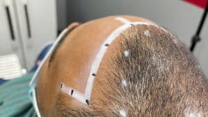 How to Restore Your Hairline Again
